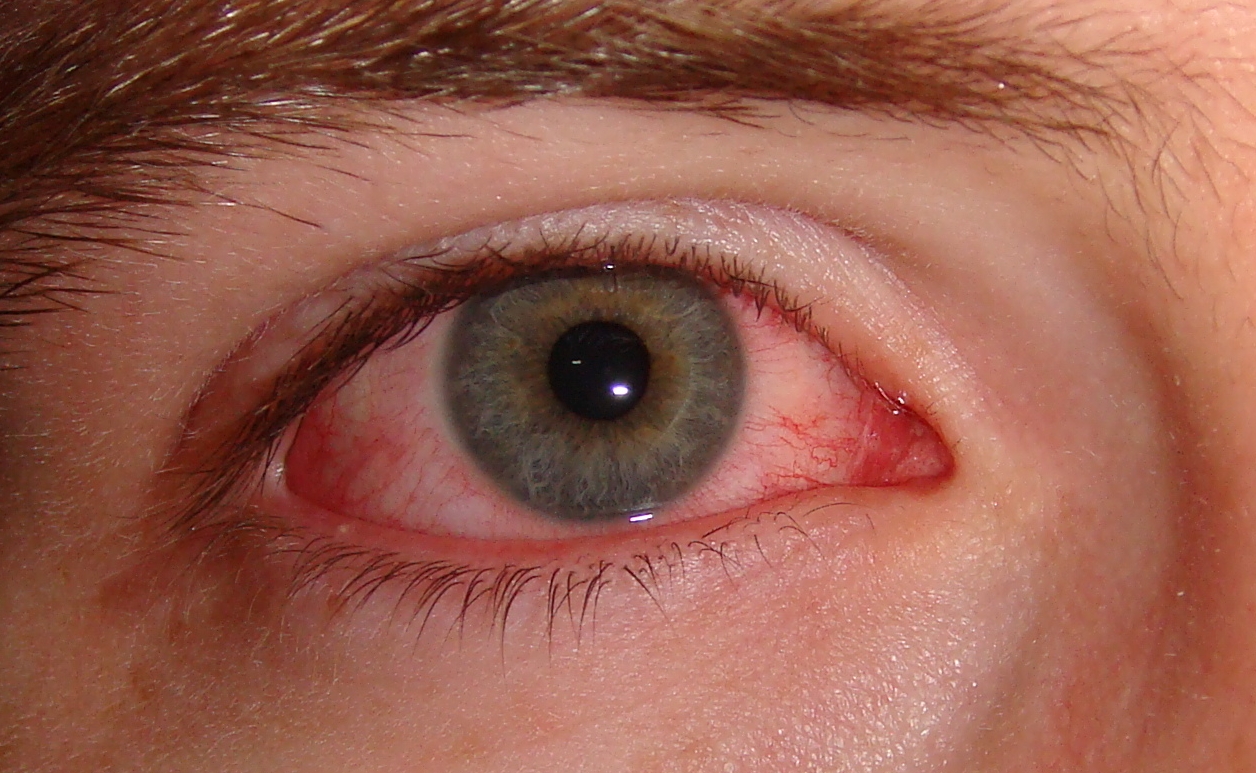 ¿Tienes los ojos rojos y te pican? Lo que debes saber sobre la conjuntivitis