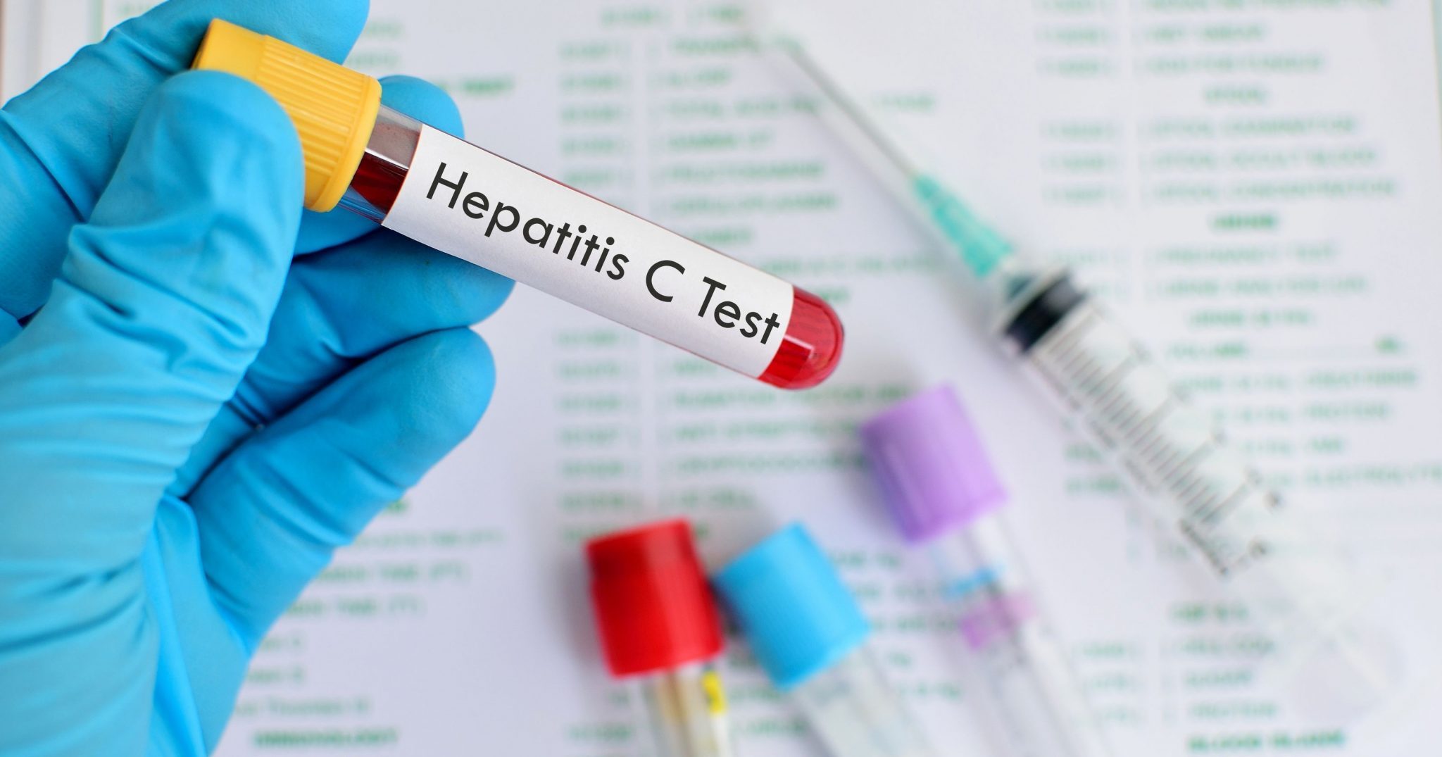 Hepatitis C: enemigo silencioso que puede causar cirrosis o cáncer