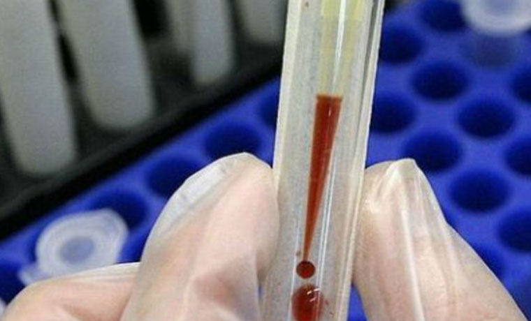 Crearon primer análisis de sangre capaz de detectar melanomas