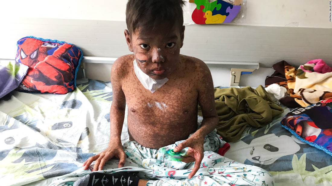 ONU denuncia que más niños mueren en hospitales venezolanos por crisis de salud