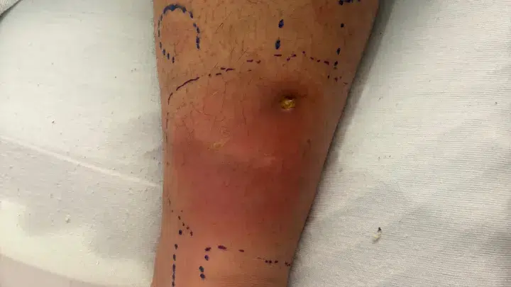 bacteria come carne Florida