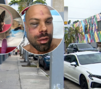 Hombre termina con el rostro fracturado tras brutal ataque de dos pitbulls en Wynwood