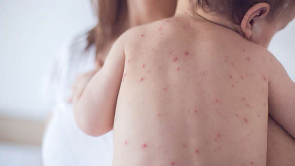 AdventHealth Centra Care reporta aumento del 700% en casos de varicela