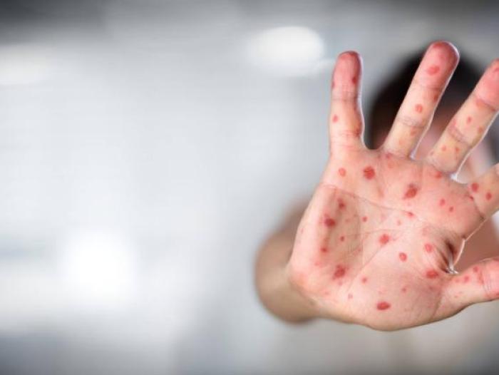 Viruela del mono para la OMS es amenaza sanitaria pero no una emergencia de salud pública