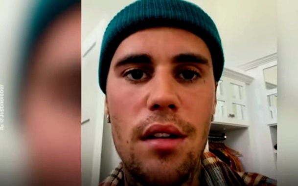 Justin Bieber reveló que tiene la mitad del rostro paralizado