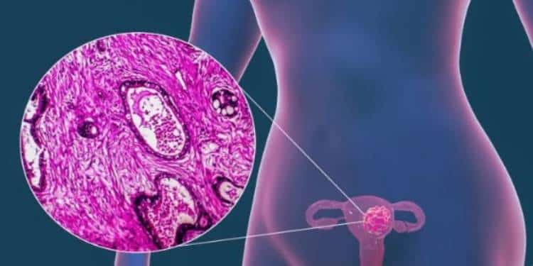 ¡Avanza la ciencia! Pacientes con cáncer de ovario podrían sanar definitivamente gracias a fármaco “milagroso”