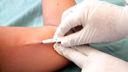Mujer casi muere después que implante anticonceptivo se movió de su brazo al pulmón