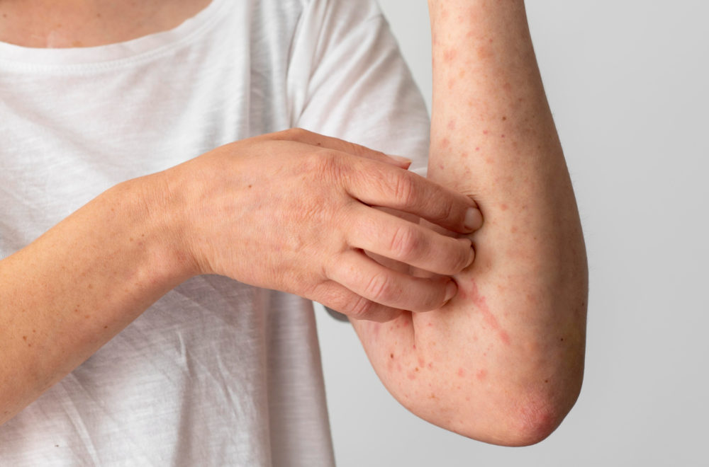 Grave infección cutánea, contagiosa y resistente a medicamentos llegó a EEUU