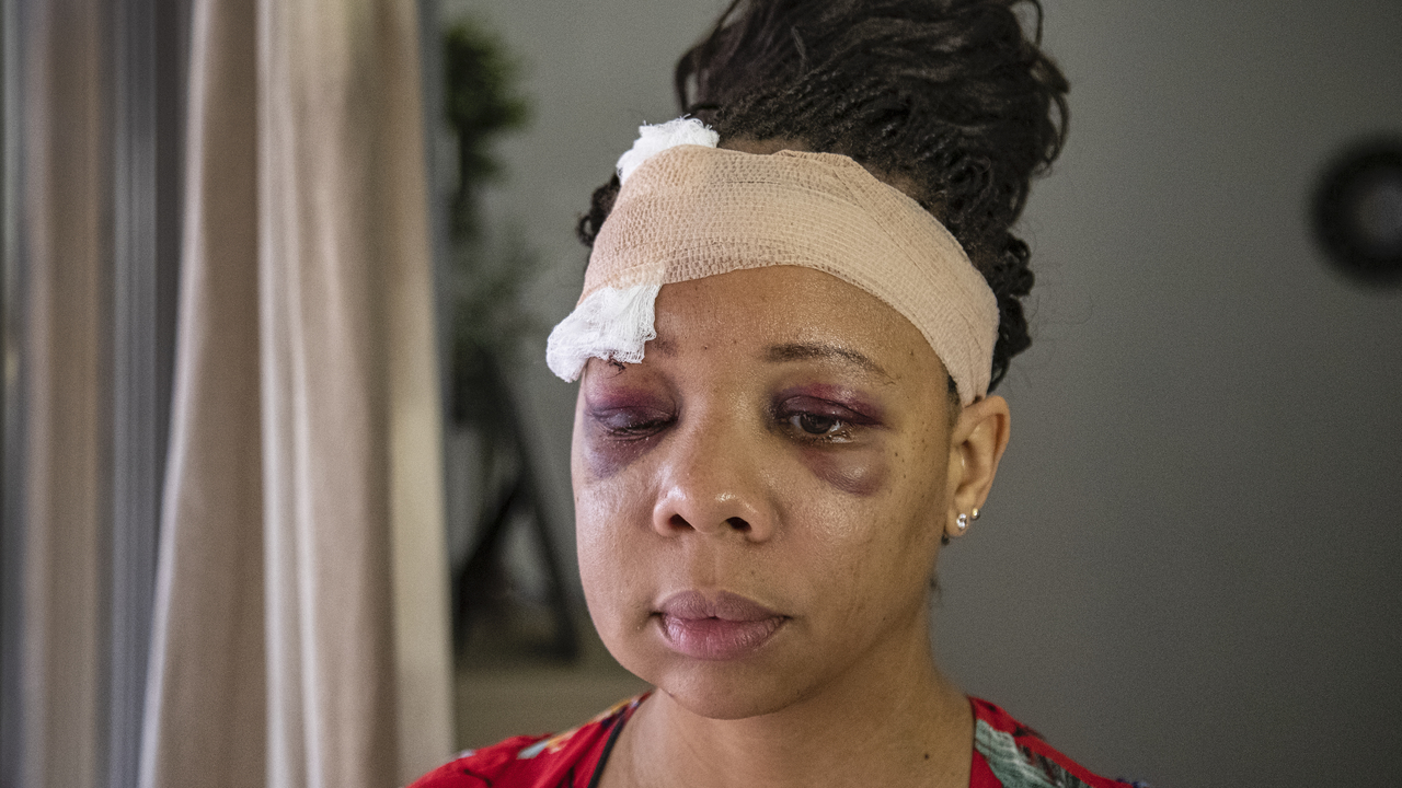 Mujer demandará a policía de Fort Lauderdale tras recibir disparo en la cara con bala de goma