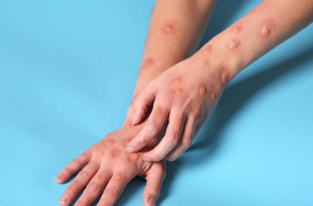 Florida en alerta: aumentan casos de Mpox en medio de nueva variante