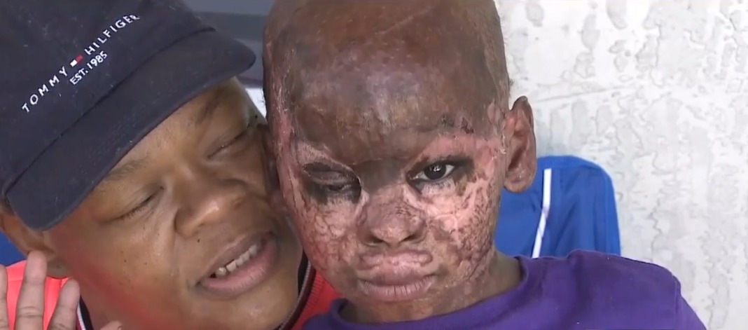 El duro relato de la abuela de niño herido en incendio de Overtown