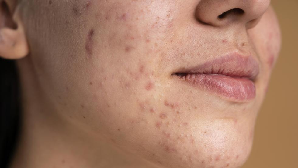 Los 7 consejos prácticos para prevenir y mejorar el acné