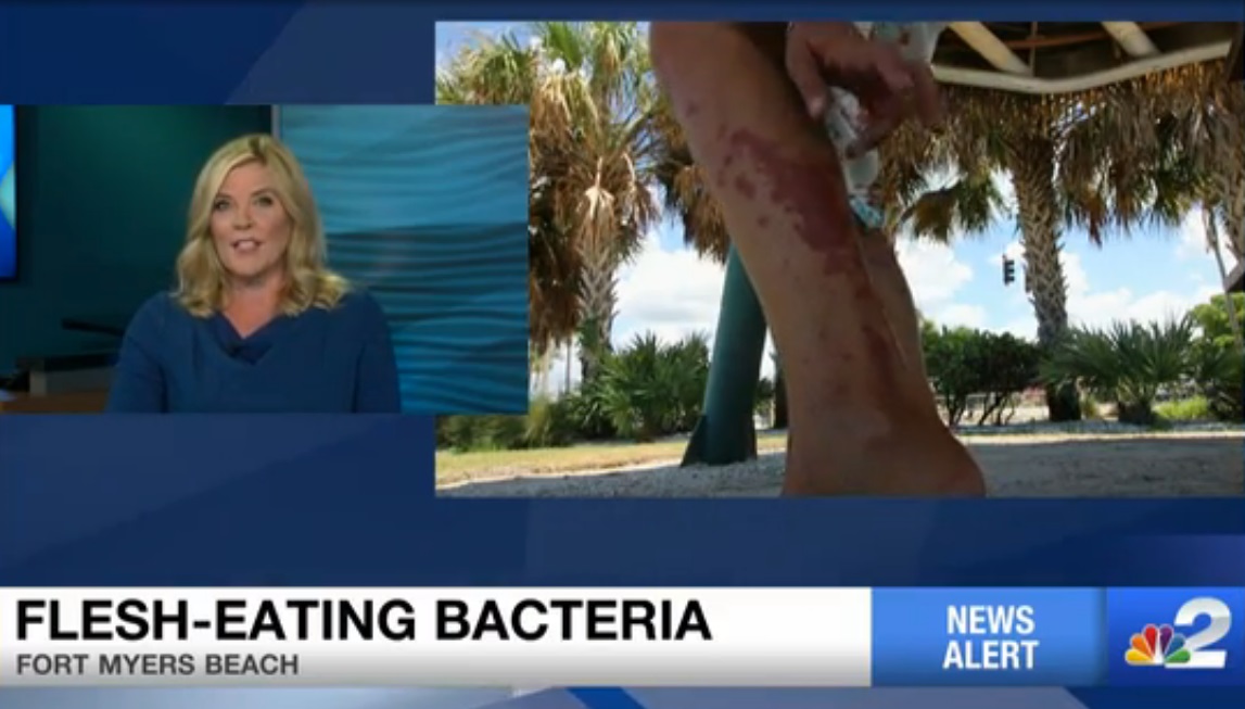Bacteria “come carne” hace de las suyas en Florida