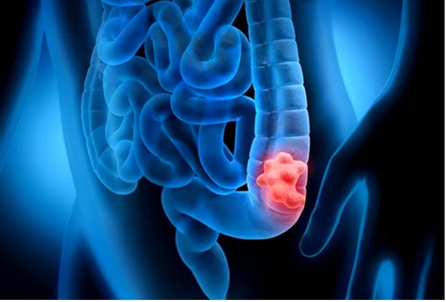 Los antibióticos aumentan el riesgo de desarrollar cáncer de colon