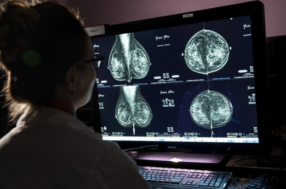 Sistema con IA podría detectar cáncer de mama con años de antelación