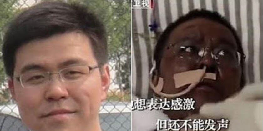 Falleció el médico chino cuya piel se volvió negra por el coronavirus