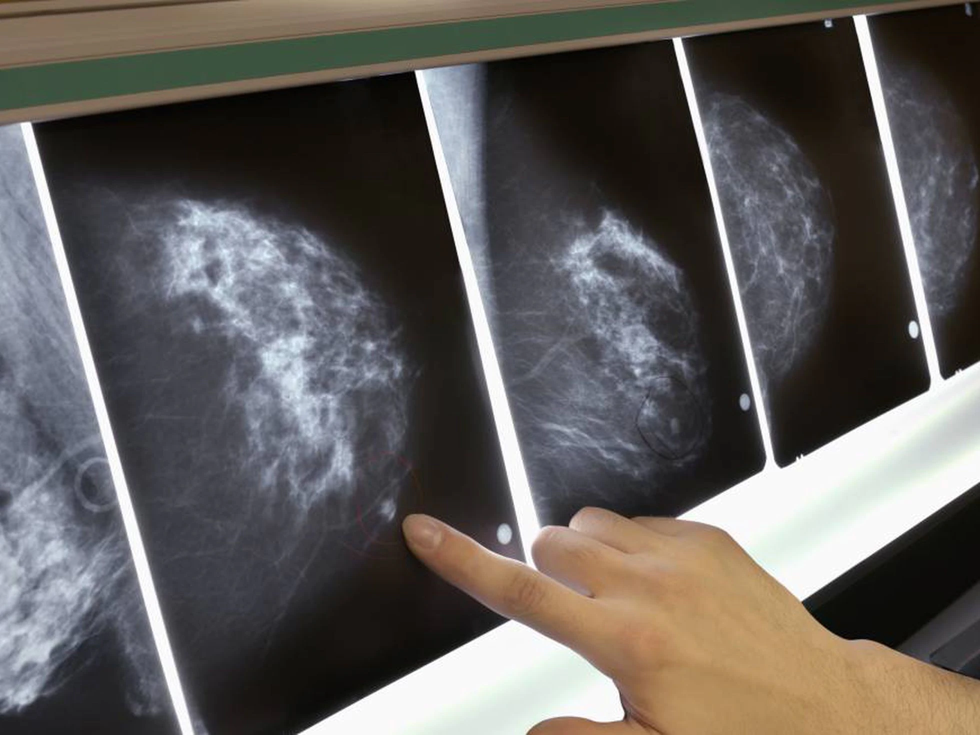 Fármaco reduce la metástasis cerebral con el cáncer de mama
