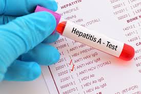 ¡Tome previsiones! Aparecen nuevos casos de hepatitis A en Florida
