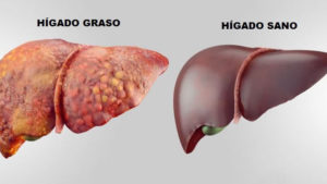 ¿Qué es el hígado graso y cómo lo puedo combatir "económicamente"?