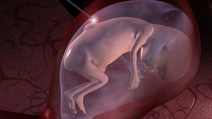 Cleveland Clinic practica la primera cirugía de útero en un feto para reparar su espina bífida