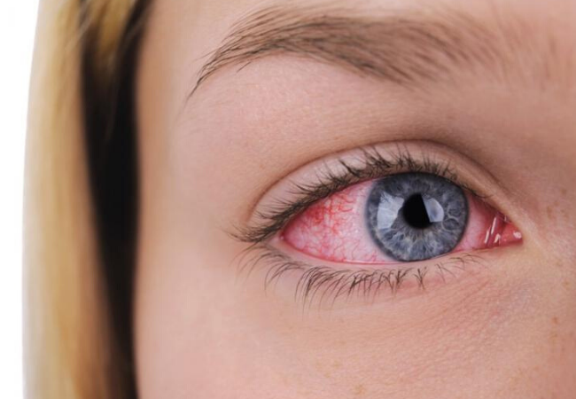 Ojos rojos…  ¿Otro síntoma del coronavirus?