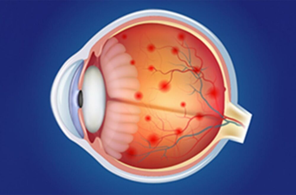 Usted podría tener retinopatía diabética, una de las causas de la ceguera