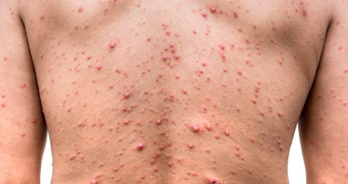 Viruela del mono: síntomas, formas de contagio y cómo evitar contraer el virus