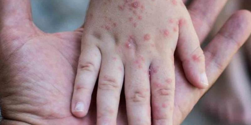 Unos 73 millones de niños están en riesgo de contraer sarampión