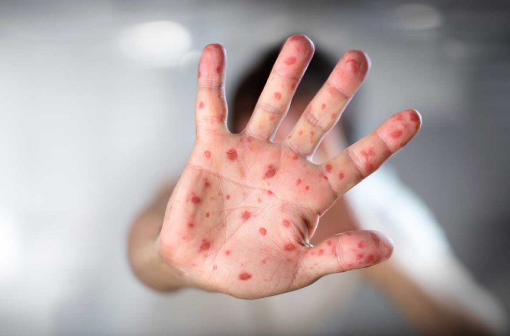 Detectan cuatro casos de sarampión en escuela de Weston: Estos son los síntomas