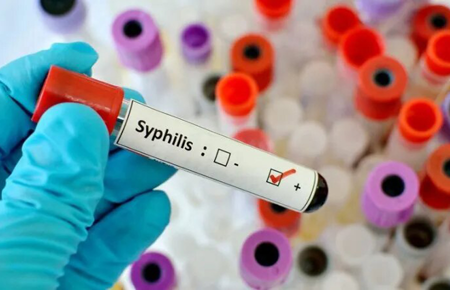 Casos de sífilis en aumento generan alarma por escasez del medicamento en EE.UU