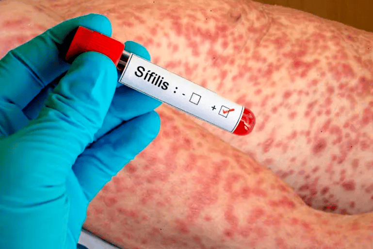 Autoridades sanitarias activan las alertas ante aumento de sífilis en EEUU