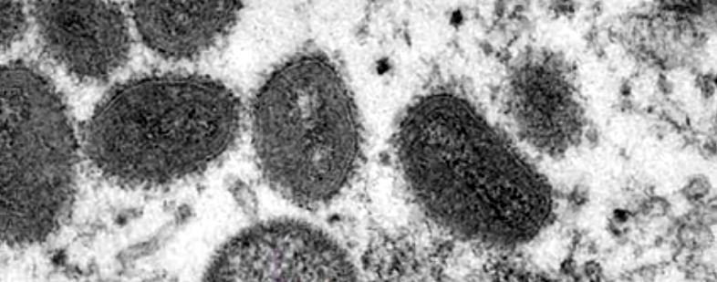Viruela del mono: Los CDC dicen que ya podría haber transmisión comunitaria en EEUU