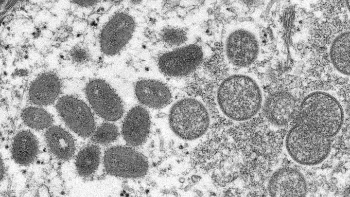 ¿Nueva pandemia? Europa en alerta sanitaria por brotes de viruela del mono