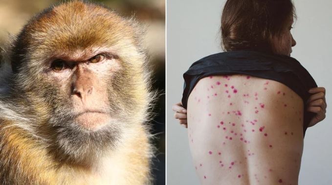 Viruela del mono: descubre sus síntomas y cómo combatirla